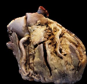 A photogrammetric 3D model of a student dissected cadaveric heart, used as a teaching aide in the SOM 613 Cardiovascular System course. 